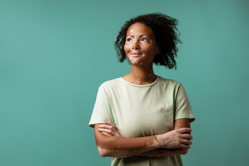 AbbVie receives positive CHMP opinion for Upadacitinib (RINVOQ) to treat adults and adolescents with non-segmental vitiligo