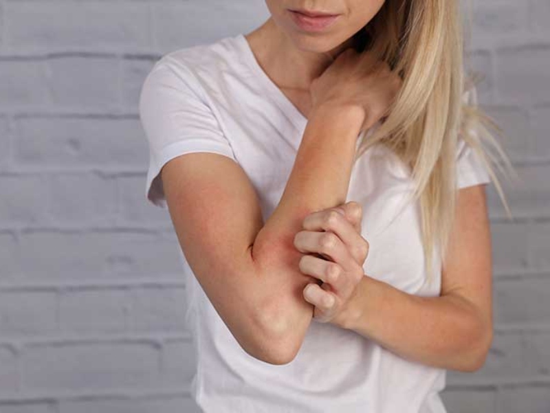 Almirall looks to raise awareness about atopic eczema