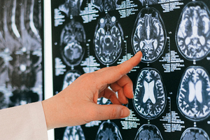 Alzheimer's drug lecanemab deemed unsuitable for the UK NHS by health regulator
