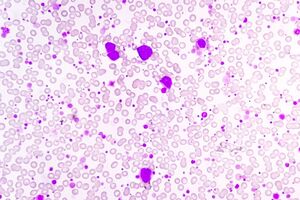 Amphista Therapeutics nominates first clinical candidate AMX-883, a novel Targeted Glue degrader for acute myeloid leukaemia