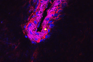 Antimicrobial therapy can prevent sepsis in pneumonia patients