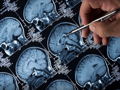 Antiulcer drugs do not increase risk of Alzheimer’s disease