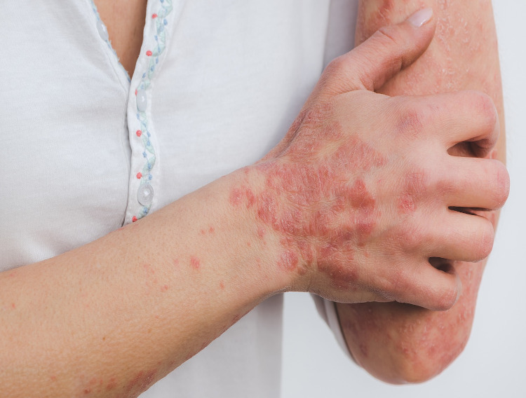 Arctic Bioscience awarded grant for herring roe psoriasis treatment