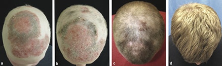 Arthritis drug reverses alopecia universalis