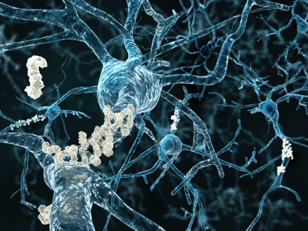 Alzheimer’s disease – neurons with amyloid plaques