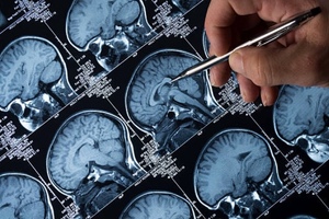 At the frontier of brain tumour research, leave no stone unturned