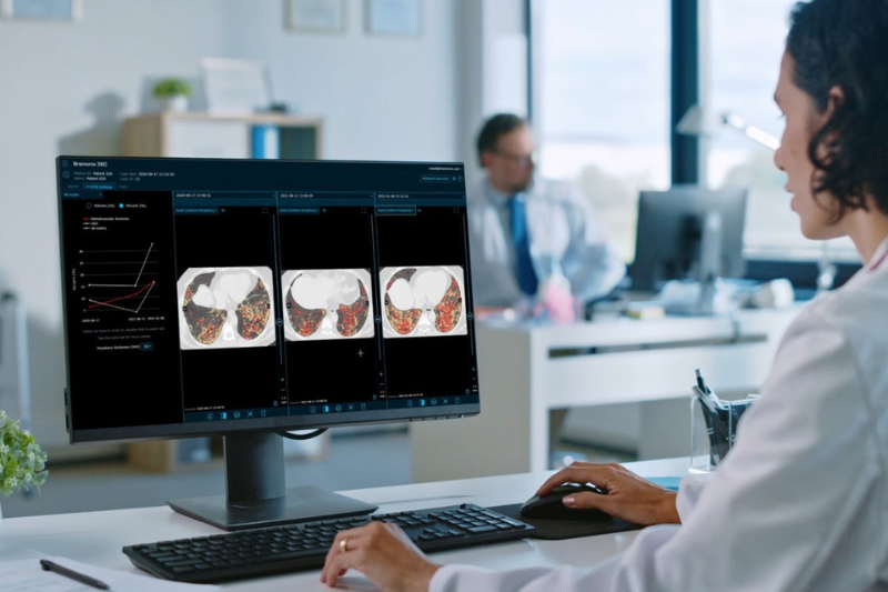 Brainomix and Boehringer Ingelheim continue partnership in pulmonary fibrosis