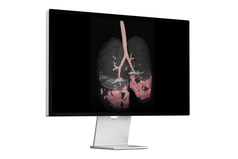 Brainomix receives FDA clearance of e-Lung AI software