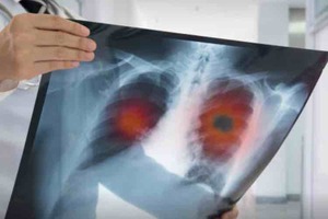 Cancer Research UK tests unique lung cancer vaccine