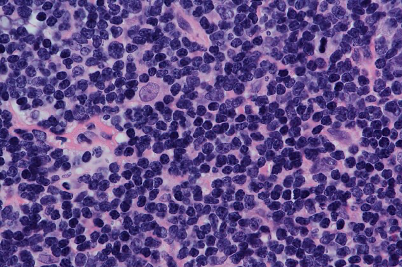 CAR-T immunotherapy Carteyva approved in China for patients with R/R MCL