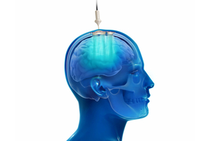 Carthera's carboplatin receives Orphan Drug Designation for use in malignant glioma