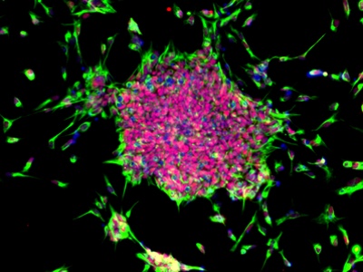 Censo and Leeds University create iPSCs from cancer tissue
