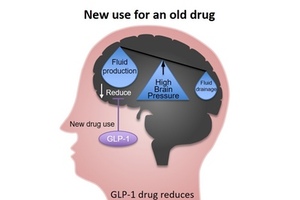 Diabetes drug reduces sight threatening rise in brain pressure 