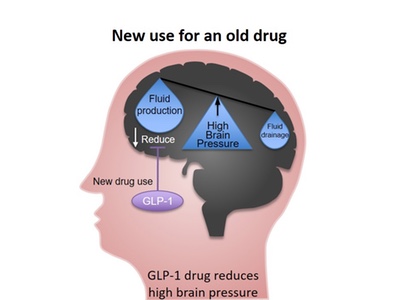 Diabetes drug reduces sight threatening rise in brain pressure 