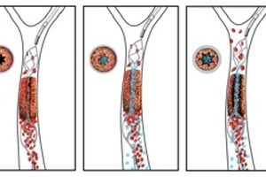 Drug-device combination opens potential path to treat stroke