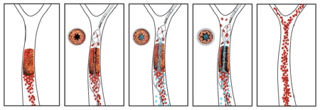 Drug-device combination opens potential path to treat stroke