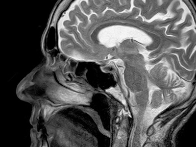EMA calls for suspended authorisation of gadolinium contrast agents 