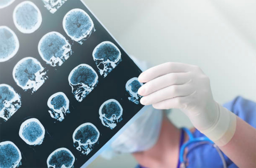 Genetic study of epilepsy points to potential new therapies