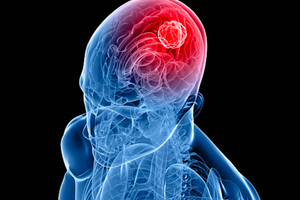 Global glioblastoma market set to reach $1.4bn by 2027