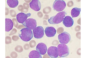 Haematological cancers pipeline one of the strongest in oncology