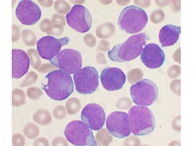 Haematological cancers pipeline one of the strongest in oncology