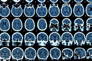 Huntington's breakthrough: gene therapy appears to slow progression of disease by 75%