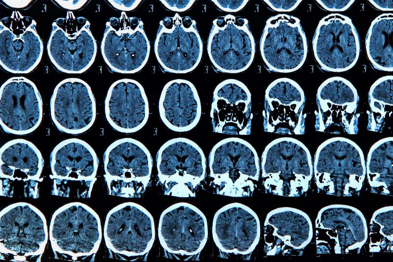 Huntington's breakthrough: gene therapy appears to slow progression of disease by 75%