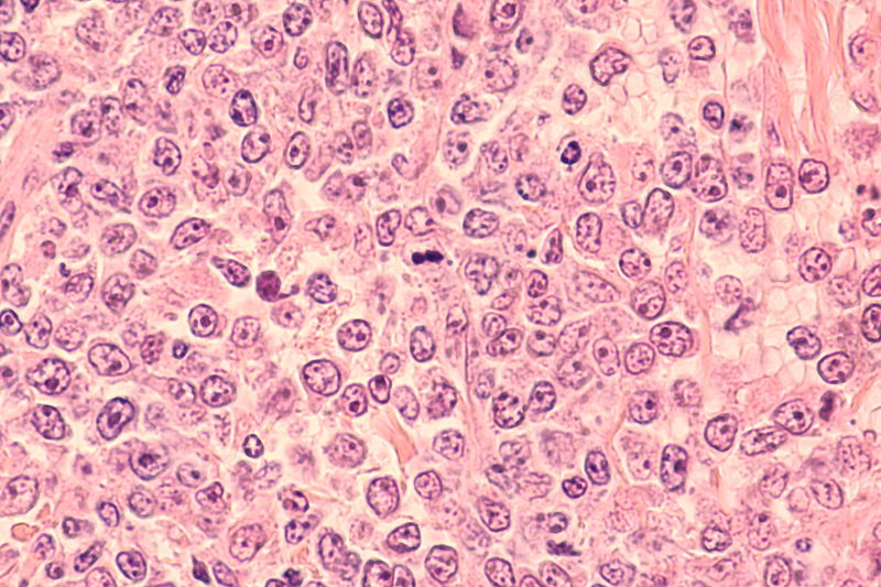 ICR London uncovers potential of tazemetostat-DOT1L inhibitor combo in blood cancer treatment