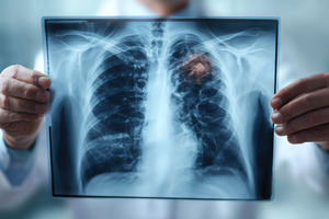 Inhaled therapies advance as clinical trial data signal progress on two respiratory fronts