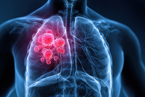Landmark NHS‑Galleri trial cuts Stage IV cancers and boosts early detection across England
