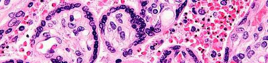 MediSieve to take blood filtration research into fight against leukaemia