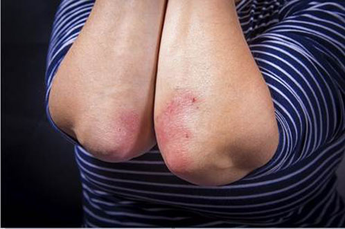 Molecule discovery holds promise for gene therapies for psoriasis