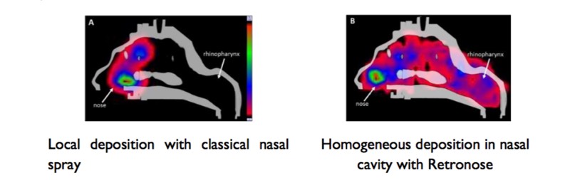 Nemera: RetroNose enhances therapeutic efficacy of nasal treatments