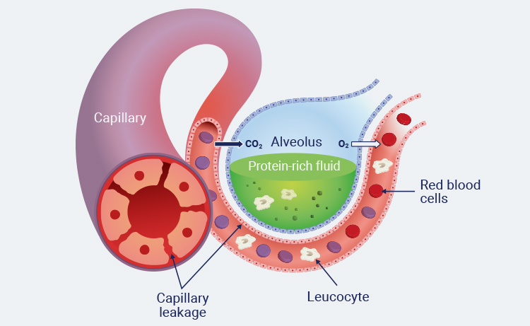 New patent protects the intravenous use of interferon-beta in a novel formulation