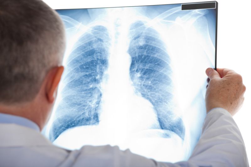New small molecule shows promise in stopping lung cancer growth