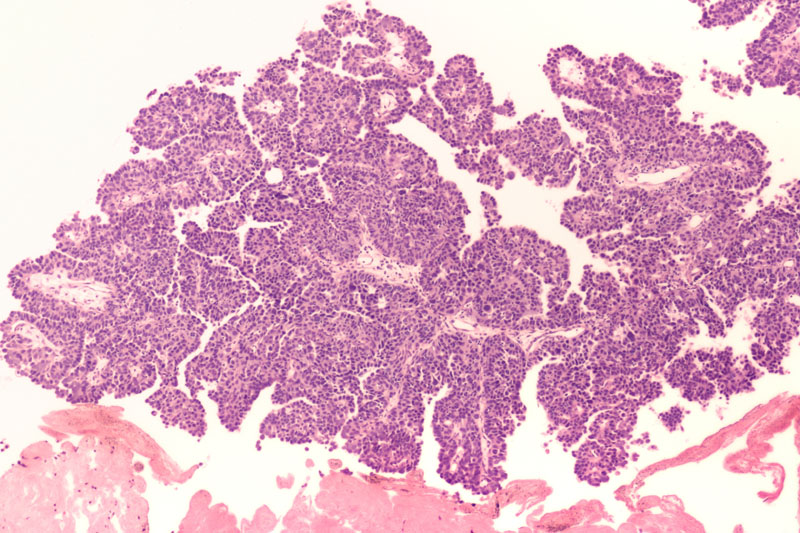 NICE recommends enfortumab vedotin with KEYTRUDA for adults in England/Wales with untreated metastatic urothelial cancer
