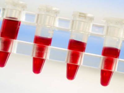 Parsortix method: new applications for circulating tumour cells