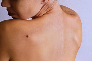 Report highlights link between the microbiome and melanoma