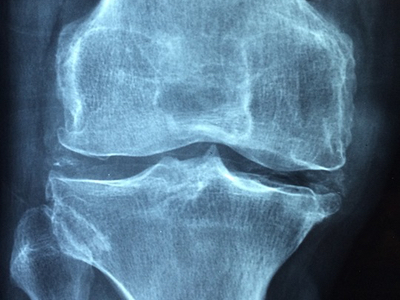 Rheumatoid arthritis market to hit $28.5bn by 2025