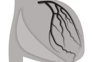 Room for progress in dyslipidemia, say GlobalData
