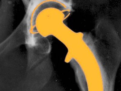 Sanger Institute doubles known osteoarthritis genes 