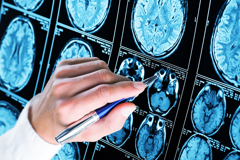 Study with Aptar’s nasal delivery system validates insulin spray for direct-to-brain Alzheimer’s drug