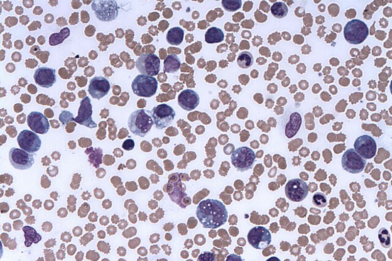 Syndax Pharmaceuticals' leukaemia drug Revuforj bags FDA approval