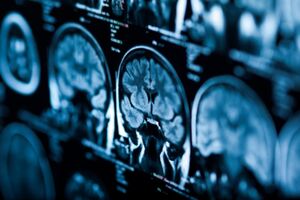 Theranexus rebrands as THX Pharma as it prepares to register and commercialise its drug candidates for rare neurological diseases