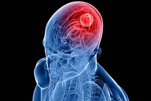 Virus could treat brain tumours by boosting immune system